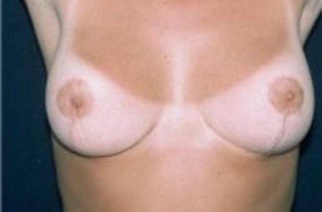 Breast Reduction Case 2 - After