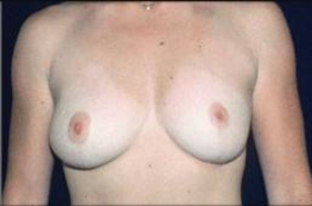 Breast Reduction Case 3 - After