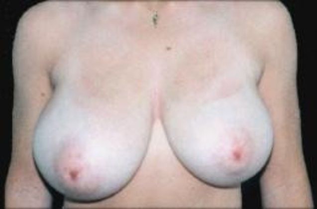 Breast Reduction Case 3 - Before