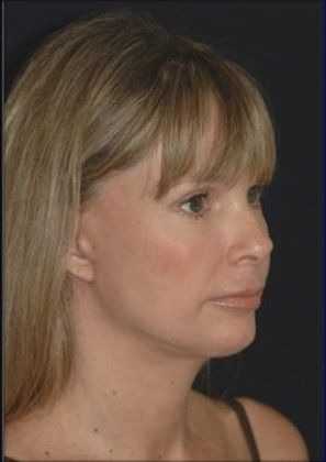 Limited Facelift Case 1 - After