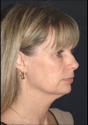 Limited Facelift Case 1 - Before