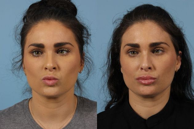 Little Rock - Cosmetic Injectables & Fillers - Before And After Gallery