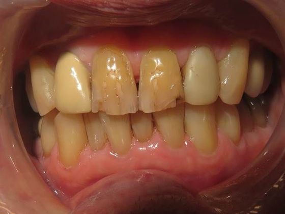 Crowns Case 1 - Before