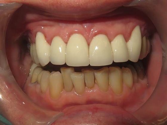 Crowns Case 1 - After