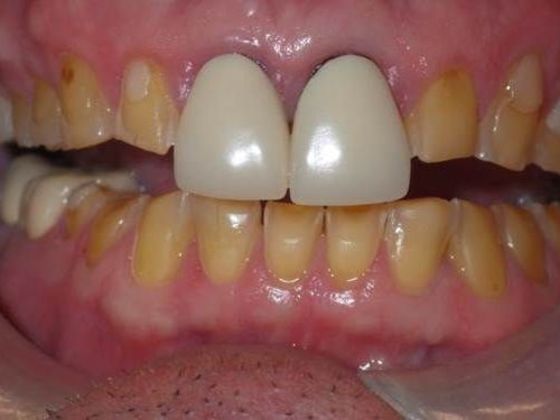 Smile Makeover Case 1 - Before