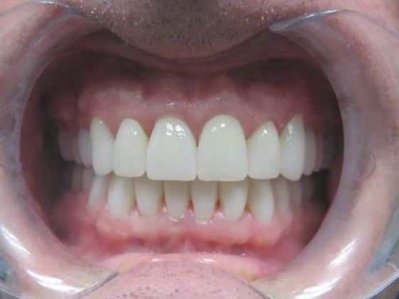 Smile Makeover Case 1 - After