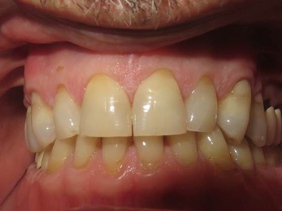 Crowns Case 2 - Before