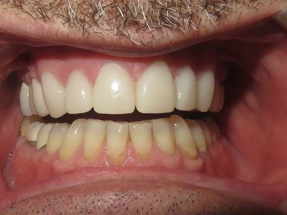 Crowns Case 2 - After