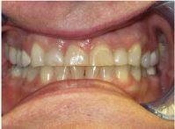 Crowns Case 3 - Before