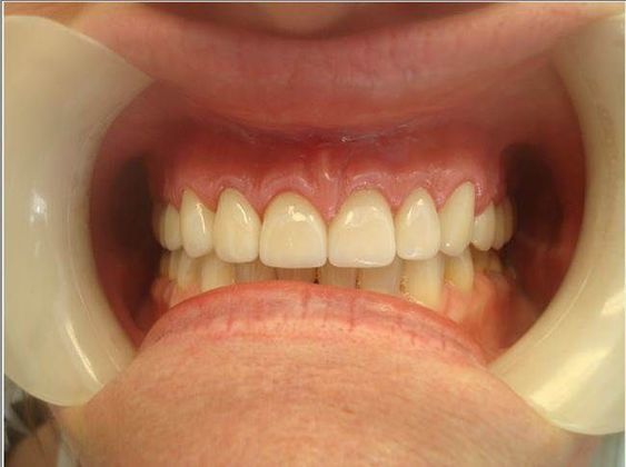 Crowns Case 3 - After