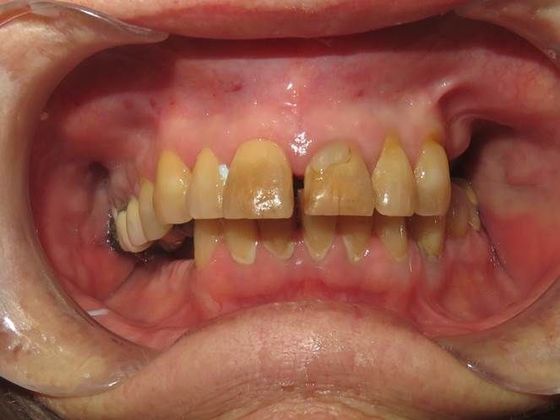 Crowns Case 5 - Before