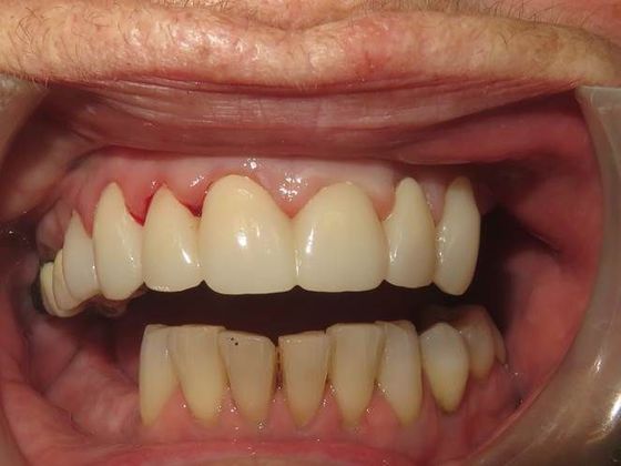 Crowns Case 5 - After