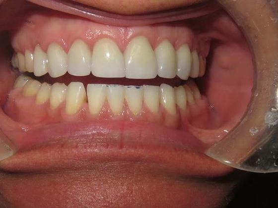 Crowns Case 6 - After