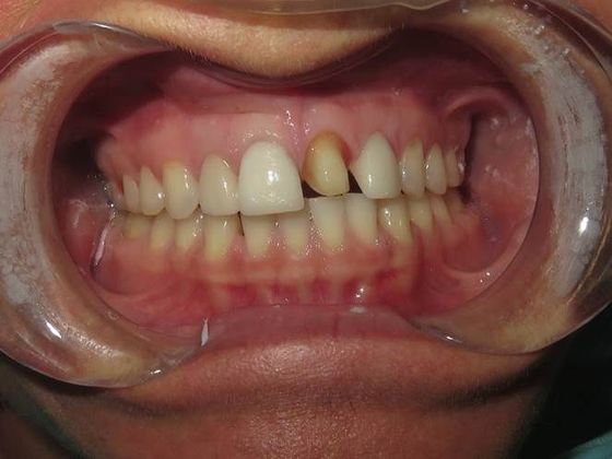 Crowns Case 6 - Before