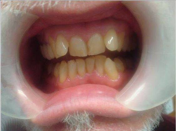 Crowns Case 7 - Before