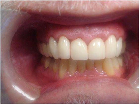 Crowns Case 7 - After