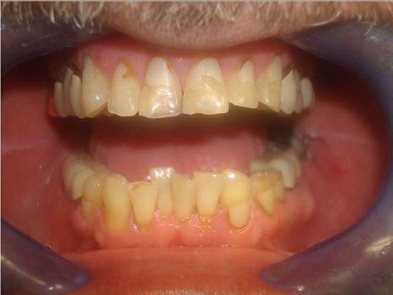 Crowns Case 8 - Before