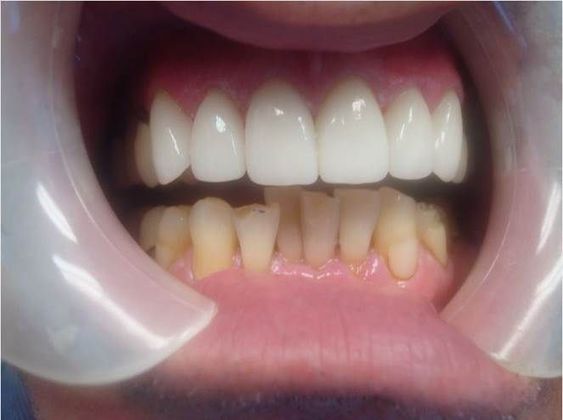Crowns Case 8 - After