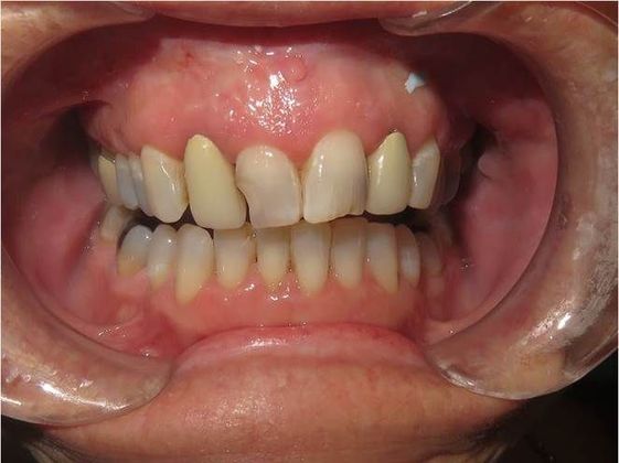 Crowns Case 9 - Before