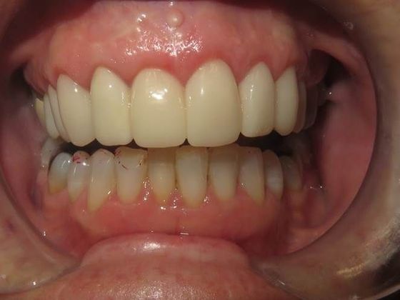 Crowns Case 9 - After