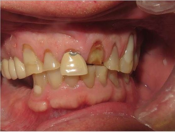 Smile Makeover Case 2 - Before