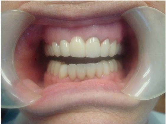 Smile Makeover Case 3 - After