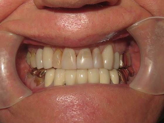 Crowns Case 10 - Before