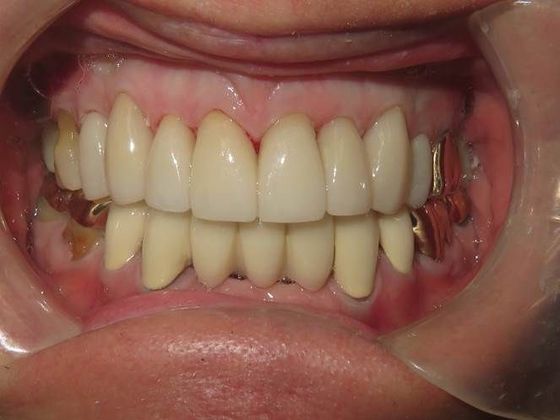 Crowns Case 10 - After