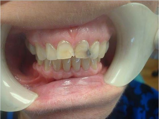 Smile Makeover Case 4 - Before