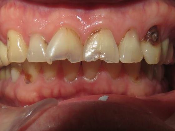 Smile Makeover Case 5 - Before