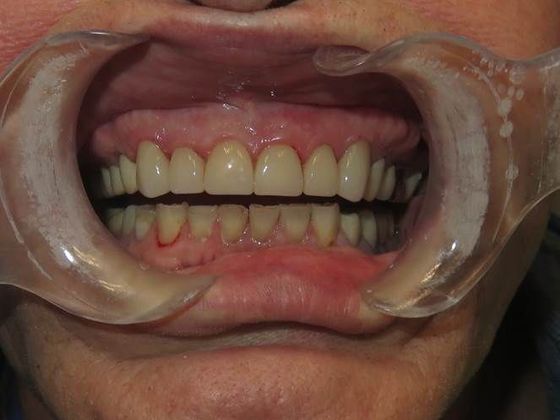 Smile Makeover Case 5 - After