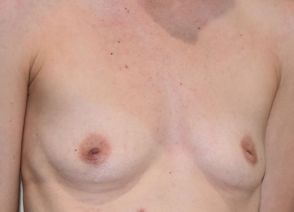 Breast Augmentation: Case 597 - Before