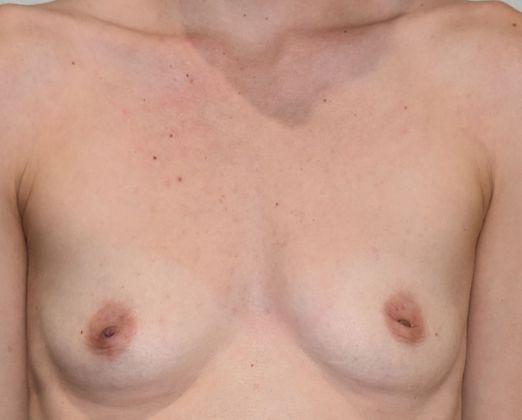 Breast Augmentation w/ Lift Case 321 - Before