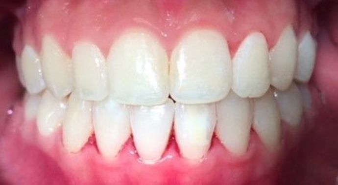after dental care