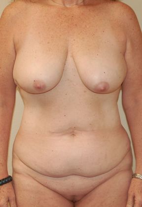 Mommy Makeover Case 159 - Before