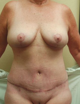 Mommy Makeover Case 159 - After