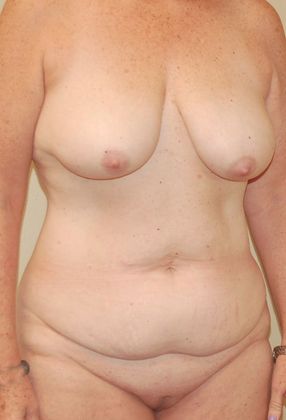 Mommy Makeover: Case 159 - Before