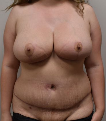 Mommy Makeover Case 161 - After