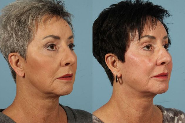 Little Rock Cosmetic Injectables And Fillers Before And After Gallery