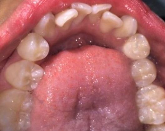 Fastbraces : 12 Months Case 4 - Before