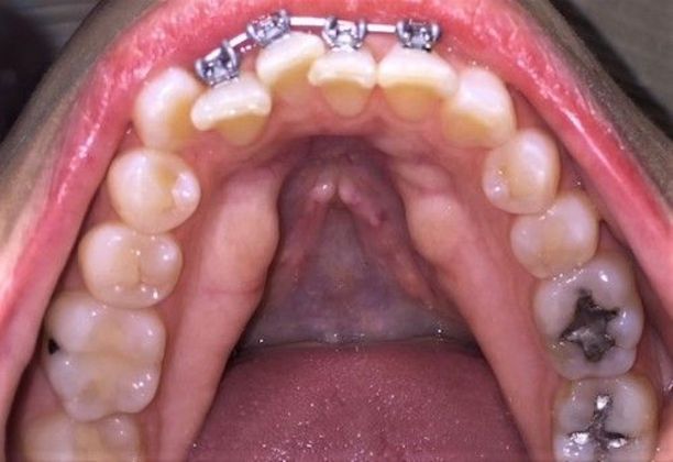 Fastbraces : 12 Months Case 2 - Before