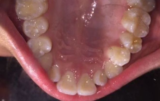 Fastbraces  12 Months Case 3 - Before