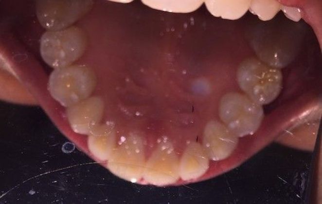 Fastbraces  12 Months Case 3 - After