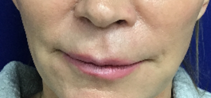 Facial Lip Lift Case 1 (30345) - Before