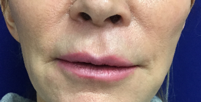 Facial Lip Lift Case 1 (30345) - After