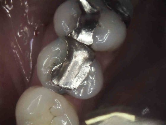 Same Day Service With Ceramic Restorations: Case 1 Removal of Silver Filling and replace with Ceramic Onlay - Before