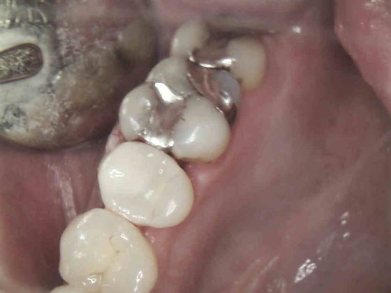 Same Day Service With Ceramic Restorations: Case 1 Removal of Silver Filling and replace with Ceramic Onlay - After