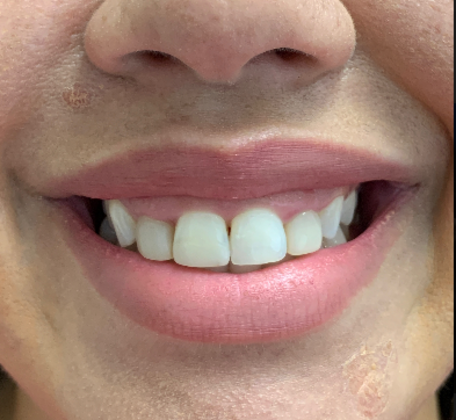 Injectables "Gummy Smile" Case 1 (20207) - Before