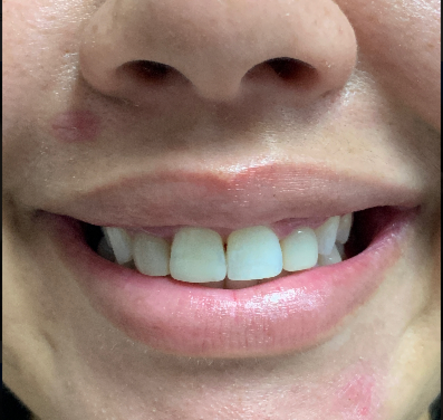 Injectables "Gummy Smile" Case 1 (20207) - After
