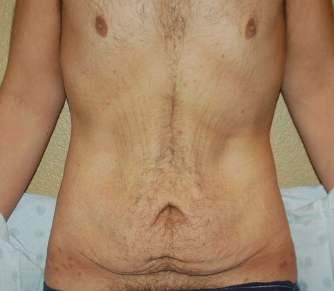 Tummy Tuck (Abdominoplasty): Case 236 - Before